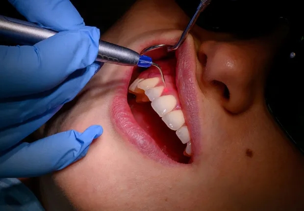 Consult stomatologic pentru tratarea gingivitei.