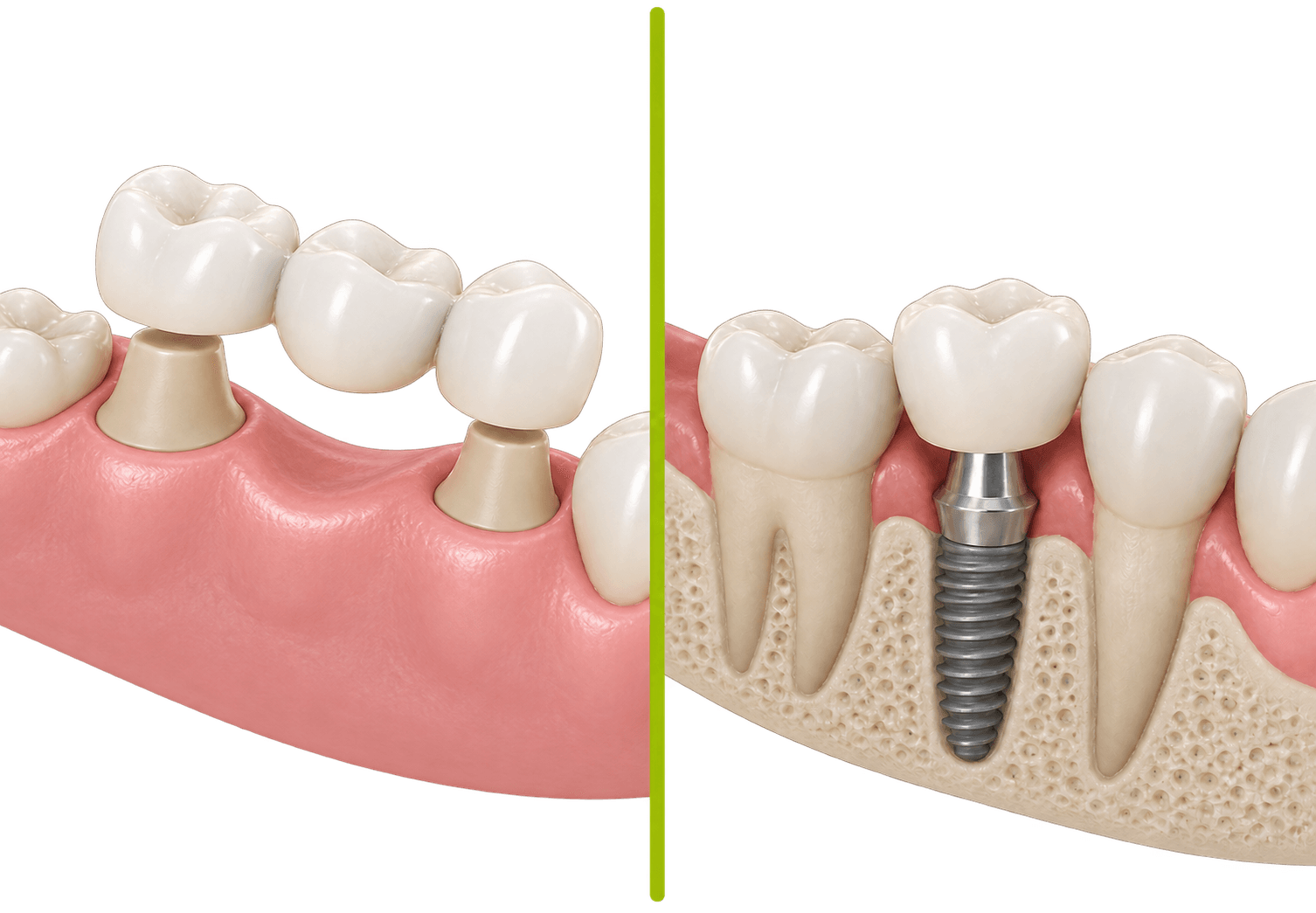 Implant vs punte dentară