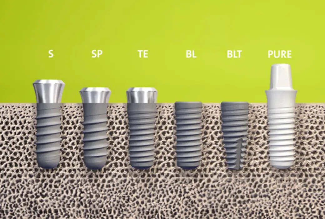 5 sfaturi pentru un implant dentar de succes. Alege corect din prima!