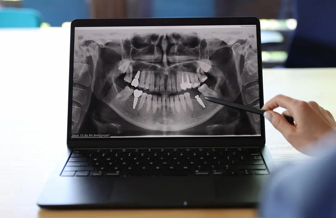 Radiografie implant dentar