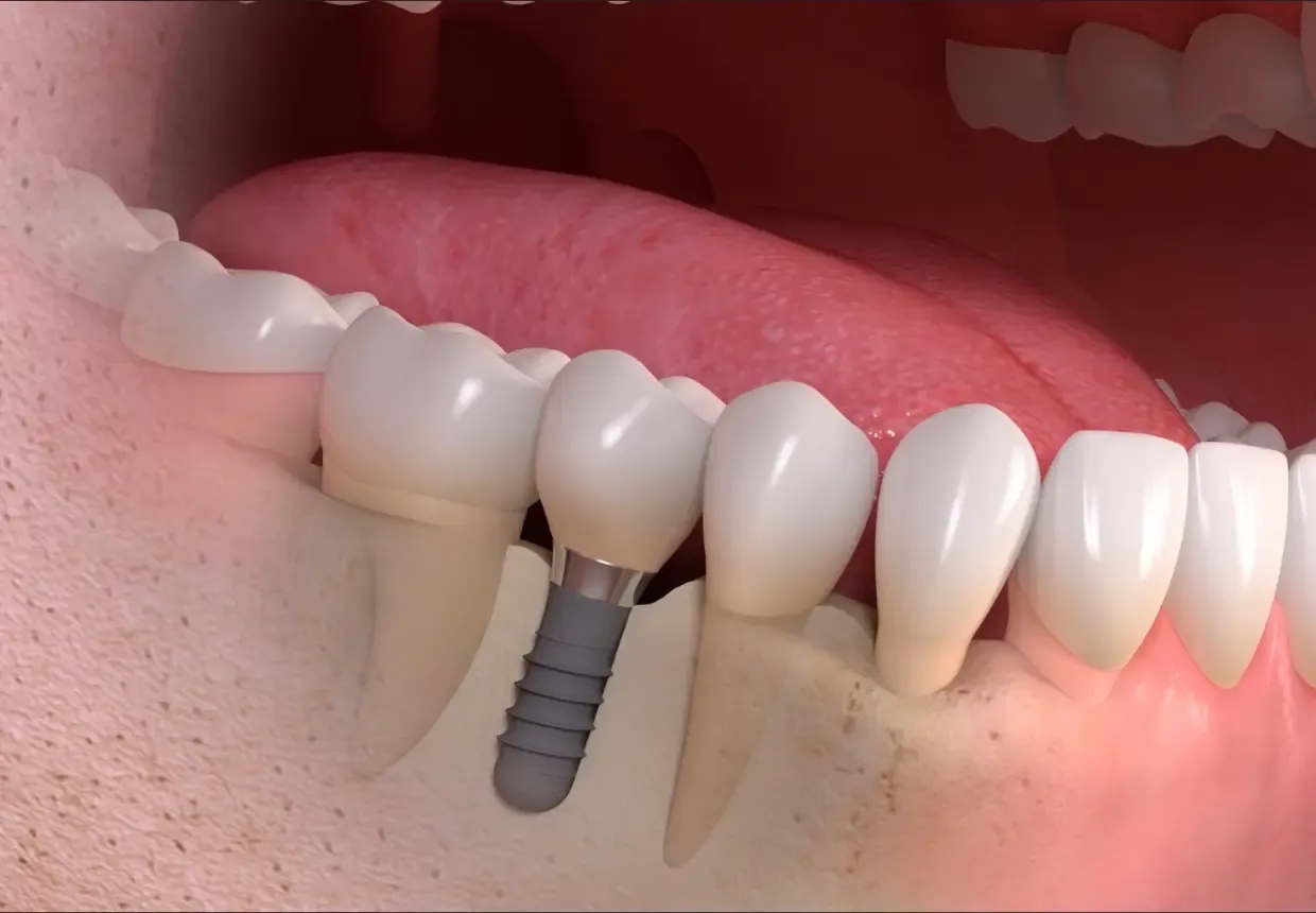 Implant dentar Straumann în cavitatea orală.
