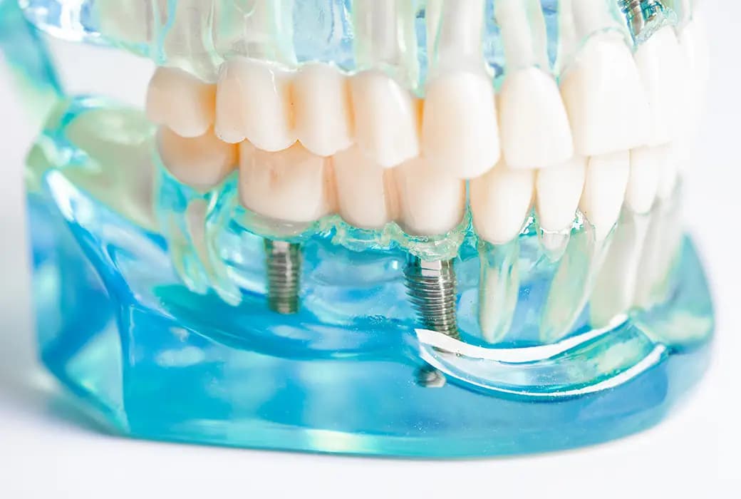Poză implant dentar