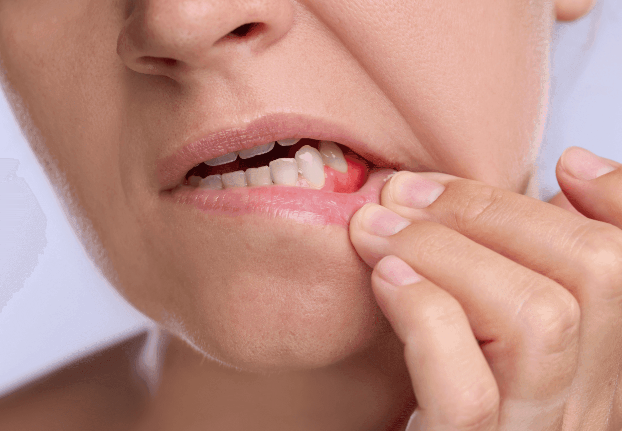 Abces gingival – simptome