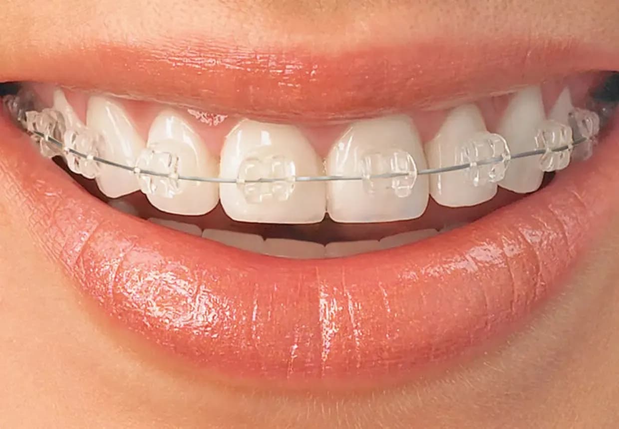 Aparat dentar safir