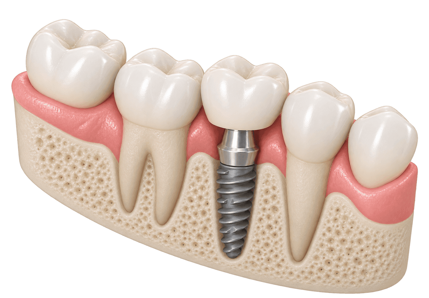 Implant dentar