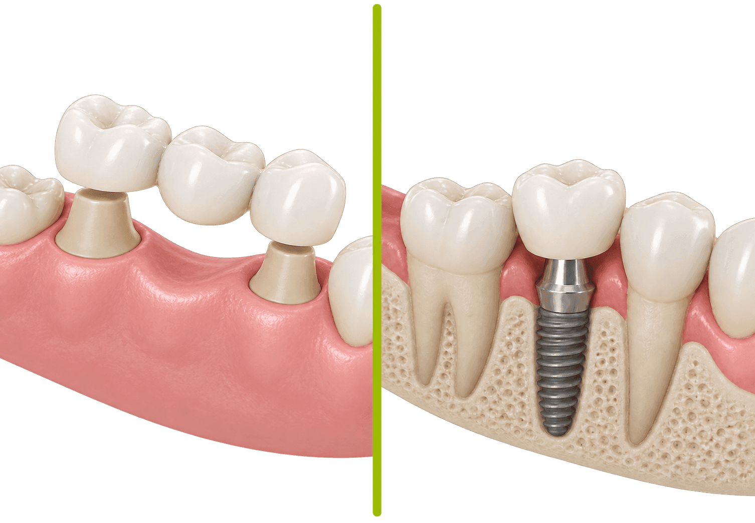Implant vs punte dentară