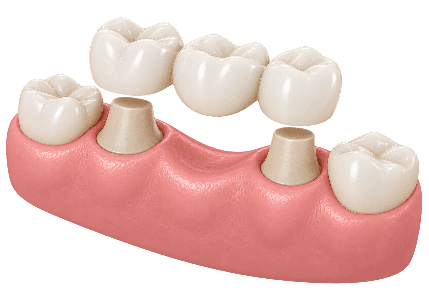 Punte dentara