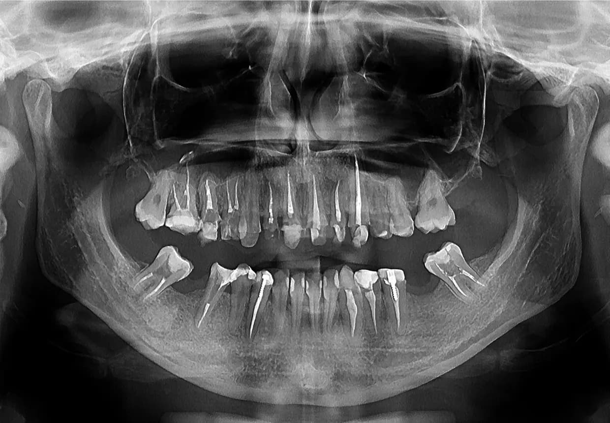 Radiografie panoramica OPG