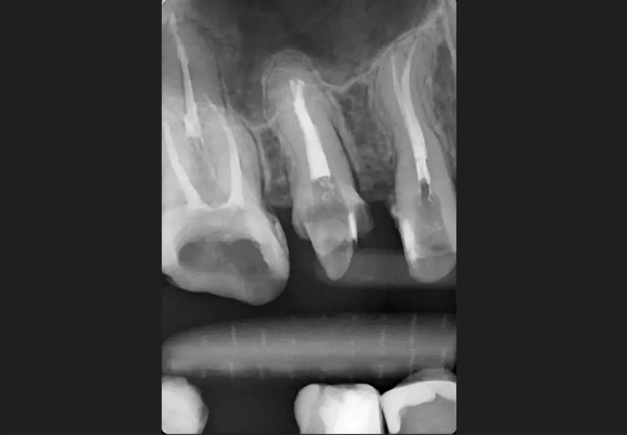Radiografie retroalveolară