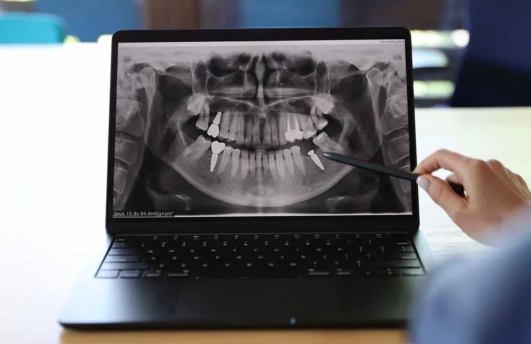Radiografie implant dentar