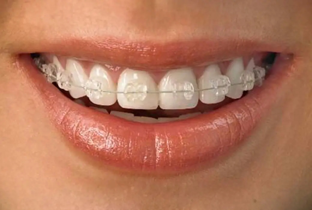 Aparat dentar ceramic – Avantaje și dezavantaje