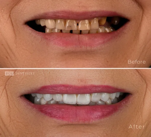 gingivectomie-estetica-dentara