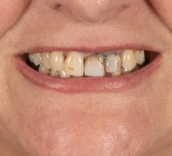 tratament-endodontic-la-microscop