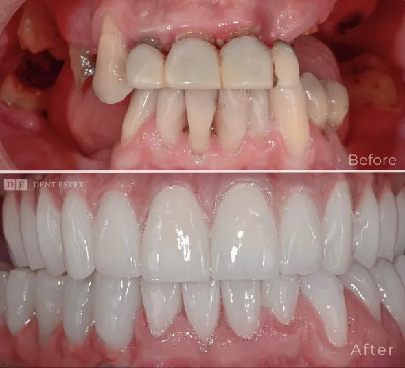 before-after-implanturi-dentare
