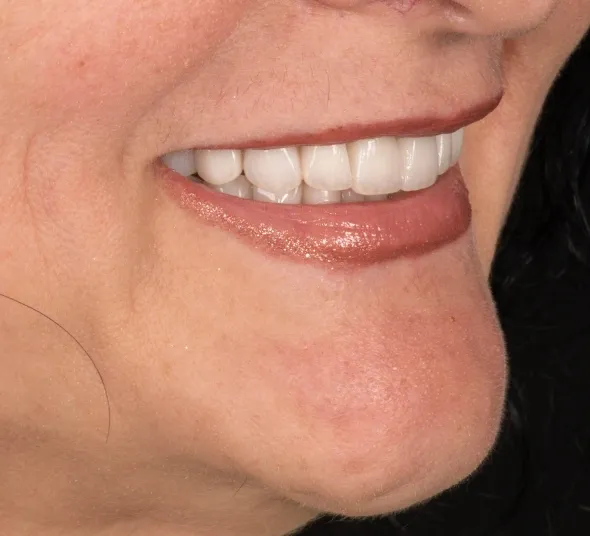 fatete-si-coroane-dentare-premium