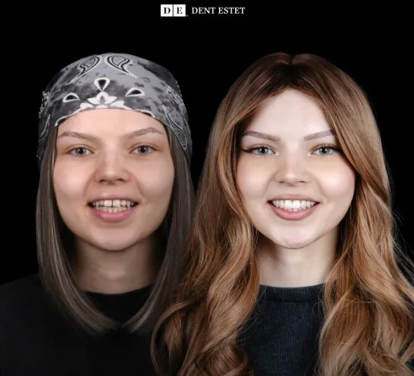 Before-after fatete dentare PREMIUM