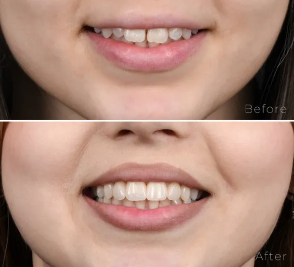 Diastema corectata prin estetica dentara