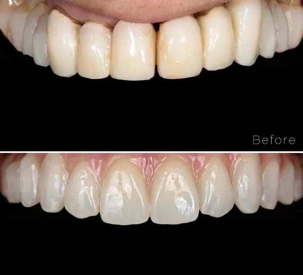 Lucrare protetica pe implanturi Straumann