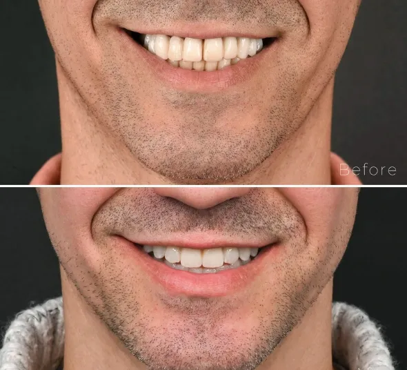 Zambet cu implanturi dentare de tip all-on-4