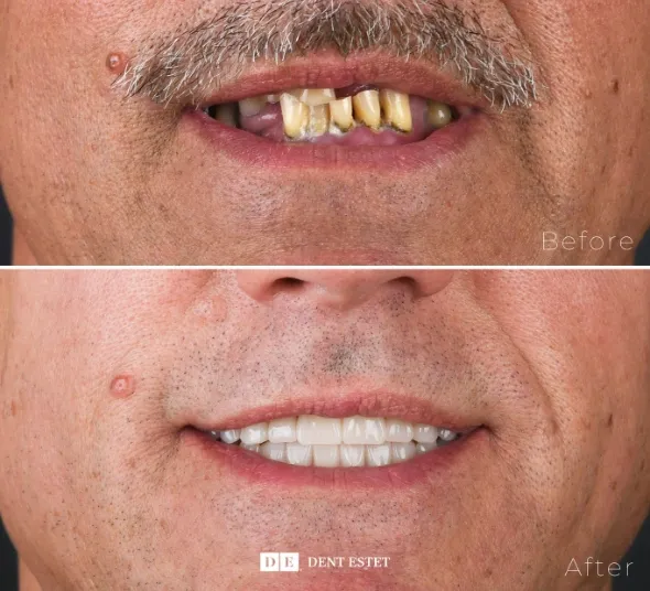 Before-After pacient implanturi de tip All-on-4