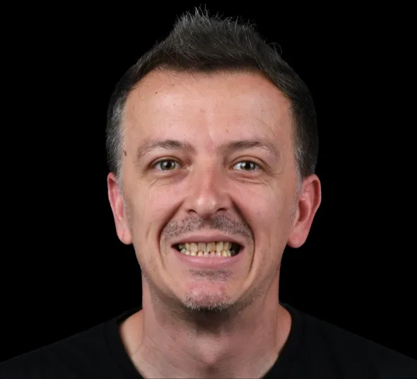 dinti-inainte-de-fatete-dentare