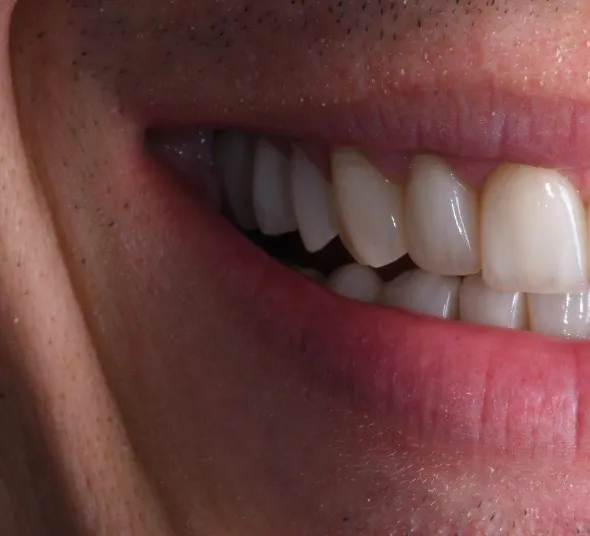 fatete-emax-reabilitare-estetica