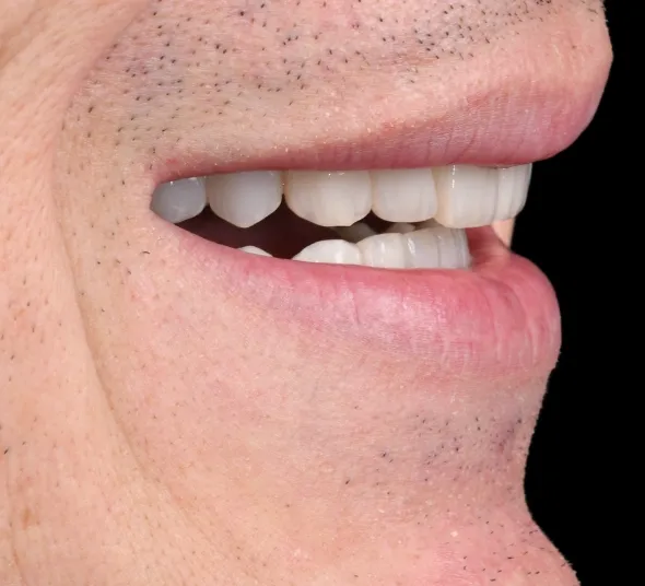 fatete-dentare-rezultat-natural