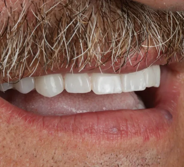 zambet final dupa implanturi