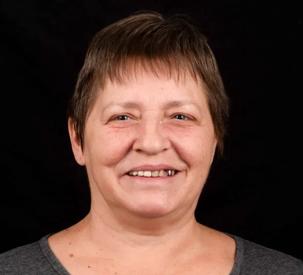 all-on-4-neodent-caz-initial