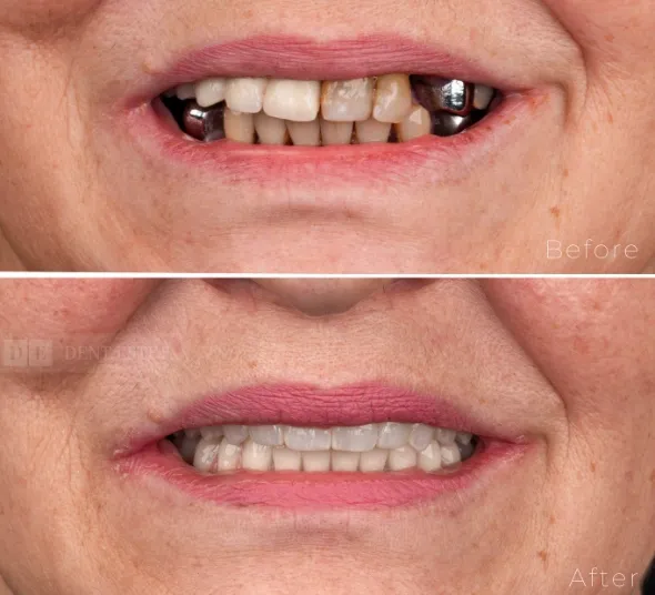 lucrare-fixa-pe-implanturi-all-on-4