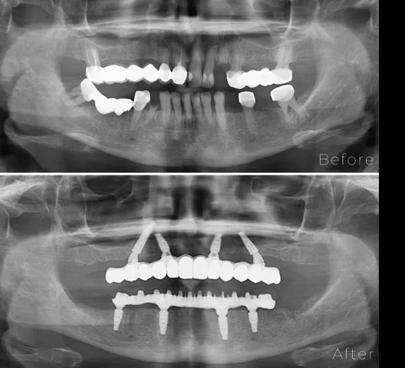radiografie-pacient-implant-dentar-all-on-4