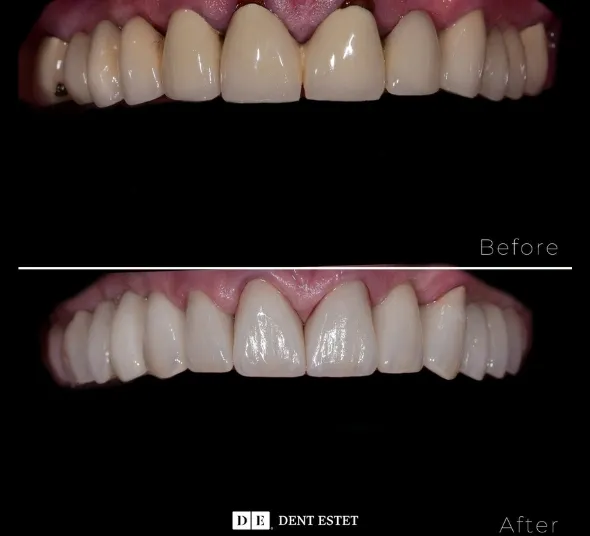 etape-tratament-implant-si-coroane