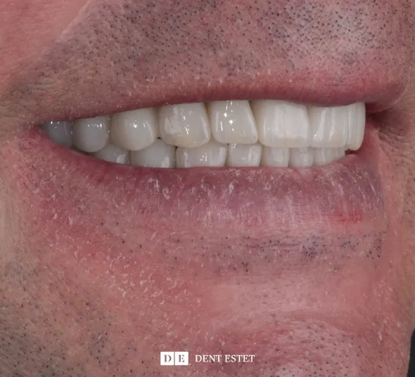 implant-dentar-brasov-rezultat-final