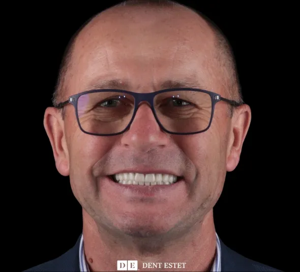 zambet-dupa-coroane-pe-implant