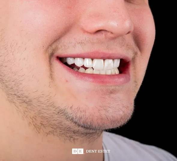 DENT ESTET