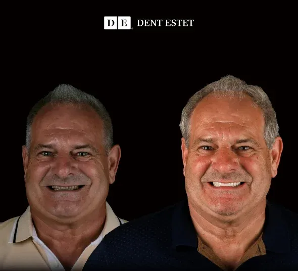 DENT ESTET