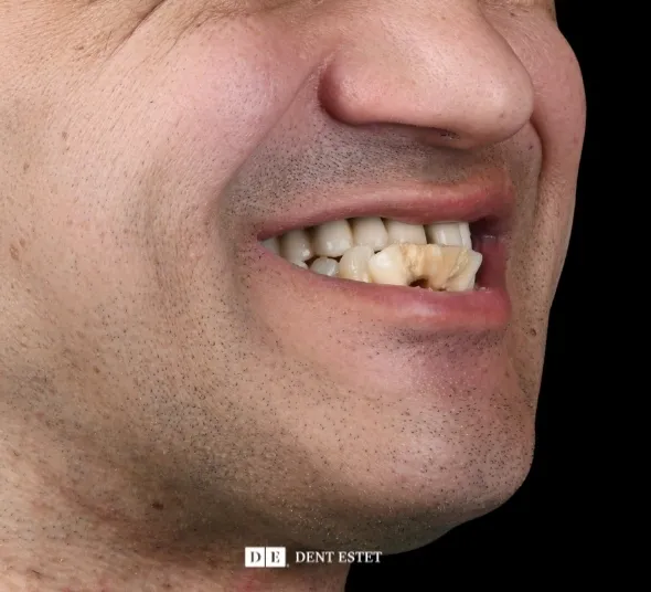 DENT ESTET
