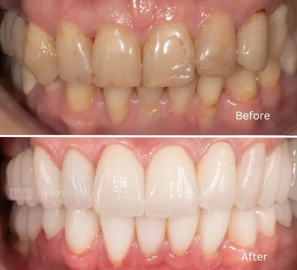DENT ESTET