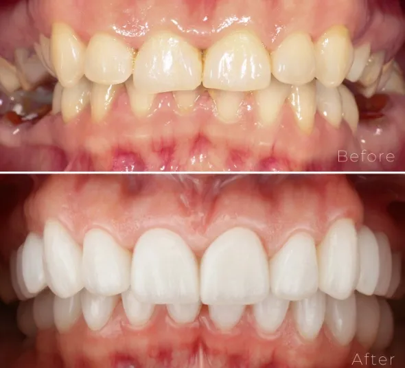 Before After fatete dentare si implanturi