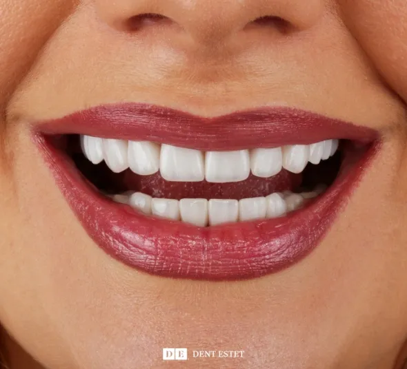 Zambet transformat cu fatete dentare