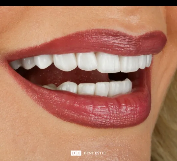 Zambet transformat cu fatete dentare