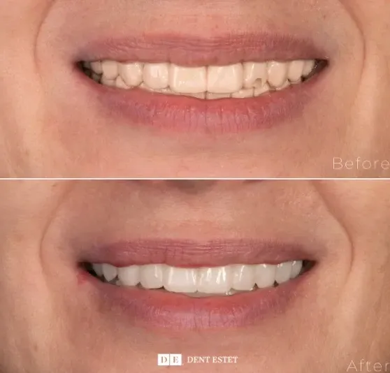 zambet-nou-cu-implanturi-dentare
