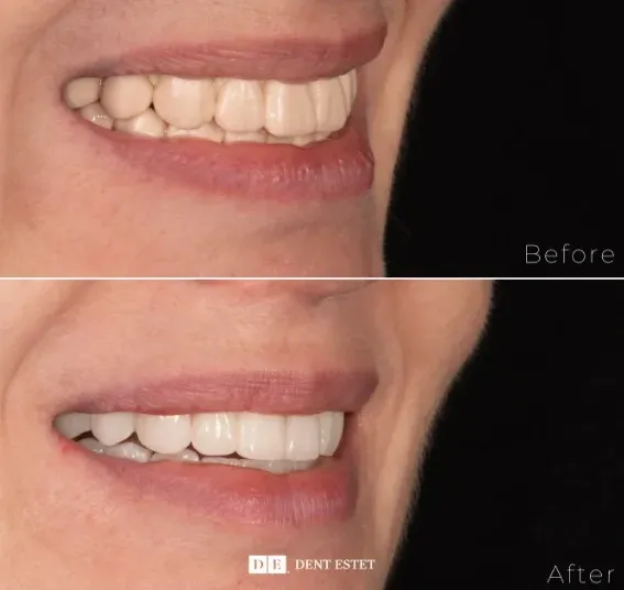 tratament-edentatie-totala-implanturi-dentare