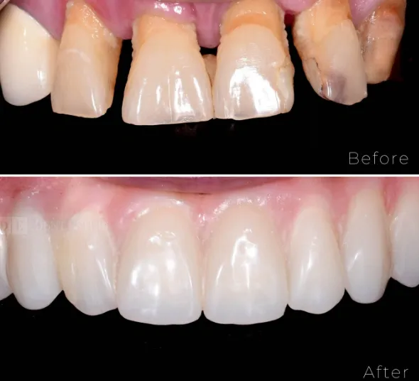 dinti-compromisi-boala-parodontala-inainte-tratament.