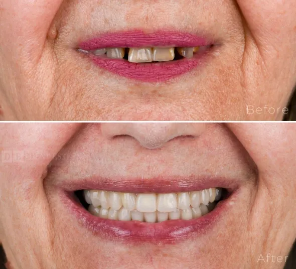 transformare-zambet-inainte-dupa-implanturi