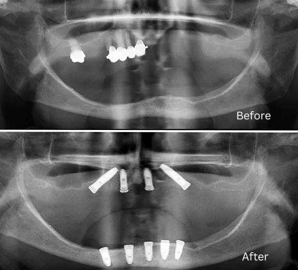 implanturi-all-on-4-pe-radiografie