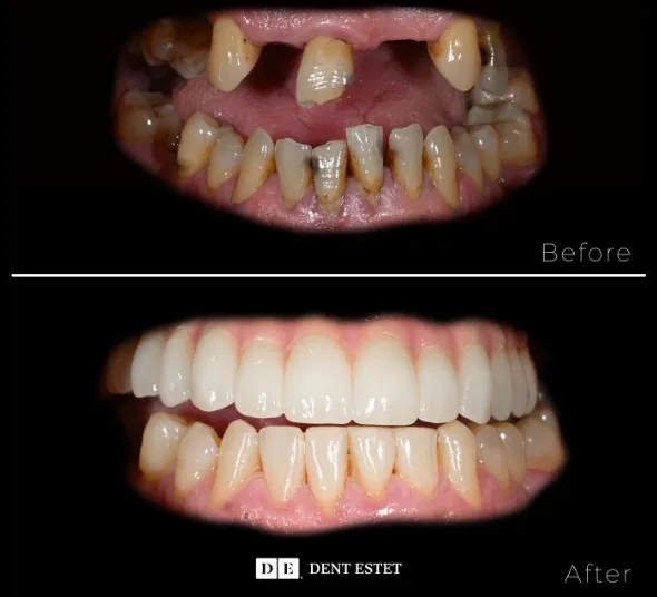 before-after-implanturi-neodent