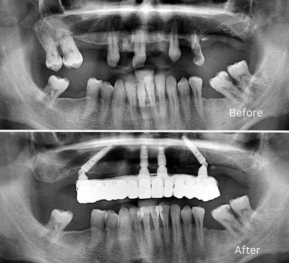 radiografie-pacient-implanturi-all-on-4