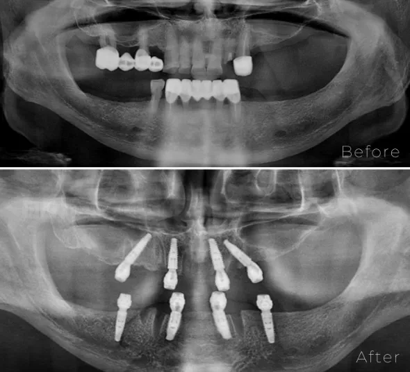 radiografie-dentara-all-on-4