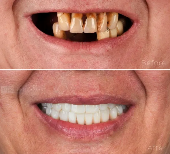 reabilitare-orala-completa-cu-implanturi-dentare